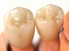  Металлокерамические зубные коронки